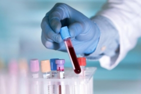 Çığır Açan Kan Testi: Baş ve Boyun Kanserini 10 Yıl Önceden Tespit Ediyor!