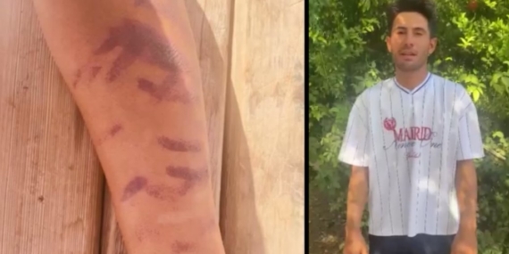 Lazer epilasyon yaptırdığı merkezde kabus yaşadı: “Ben yandım başkaları yanmasın”