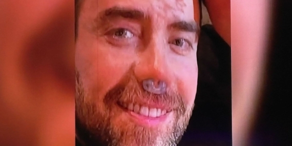 Murat Dalkılıç burnundan 12’nci kez operasyon geçirdi