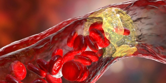 Günlük Mikroplastikler Kalp Hastalığına Yol Açabilir