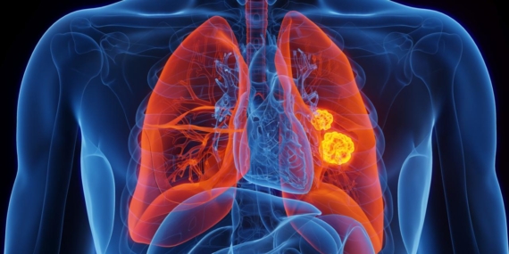 İleri evre akciğer kanserinde yenilikçi tedavi dönemi