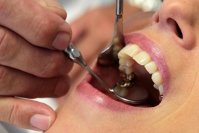 İlerleyen diş çürüğü sistemik hastalıkları tetikleyebilir