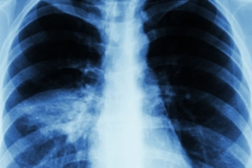 Uzmanlardan Zatürre Hakkında Önemli Uyarılar