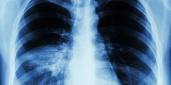 Uzmanlardan Zatürre Hakkında Önemli Uyarılar