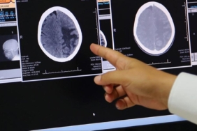 Beyin kanserinin 7 uyarı işareti kolayca gözden kaçabiliyor