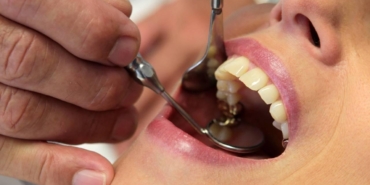 Basit bir diş çürüğü nelere yol açabiliyor?