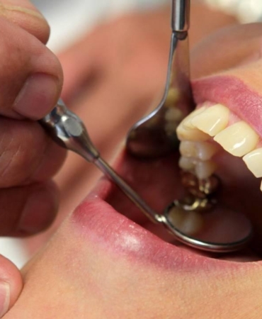 Basit bir diş çürüğü nelere yol açabiliyor?