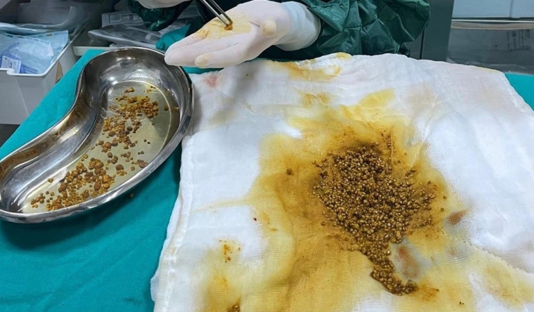 Hastanın ameliyatında 2 bin 67 taş çıkarıldı