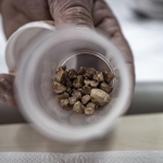 İdrar kanalından 51 taş çıkarıldı