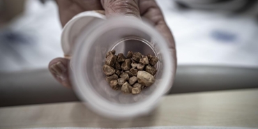 İdrar kanalından 51 taş çıkarıldı