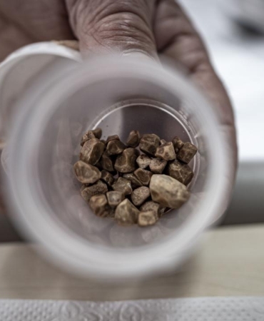 İdrar kanalından 51 taş çıkarıldı