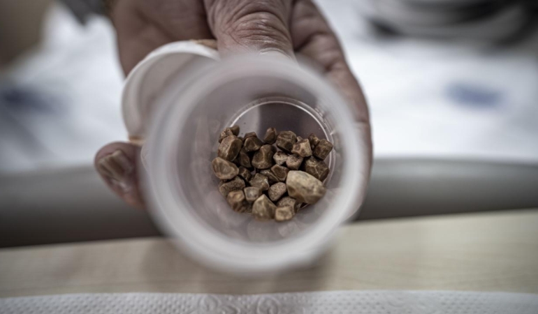 İdrar kanalından 51 taş çıkarıldı