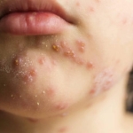 Prof. Dr. Kara'dan kızamık uyarısı: Bir kişi 18 kişiye bulaştırabilir