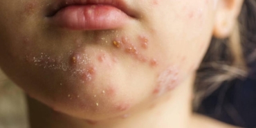 Prof. Dr. Kara'dan kızamık uyarısı: Bir kişi 18 kişiye bulaştırabilir