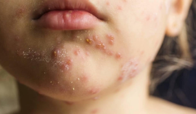 Prof. Dr. Kara'dan kızamık uyarısı: Bir kişi 18 kişiye bulaştırabilir